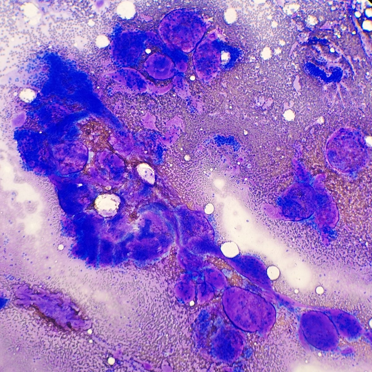 Saroja_DeviG's tweet photo. DQ-stained FNA of submandibular gland showing Adenoid Cystic Carcinoma: basaloid cells + spherules of hyaline matrix with sharp borders, unlike the fibrillary matrix of pleomorphic adenoma with embedded myoepithelial cells
#PathTwitter #MedTwitter #CytoPath #HNPath #PathResident https://t.co/3NCO2vEudG