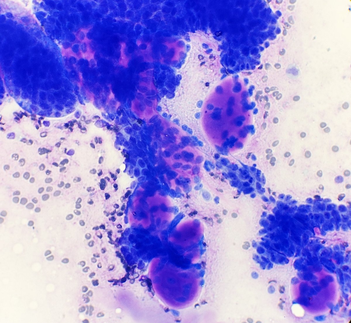 Saroja_DeviG's tweet photo. DQ-stained FNA of submandibular gland showing Adenoid Cystic Carcinoma: basaloid cells + spherules of hyaline matrix with sharp borders, unlike the fibrillary matrix of pleomorphic adenoma with embedded myoepithelial cells
#PathTwitter #MedTwitter #CytoPath #HNPath #PathResident https://t.co/3NCO2vEudG