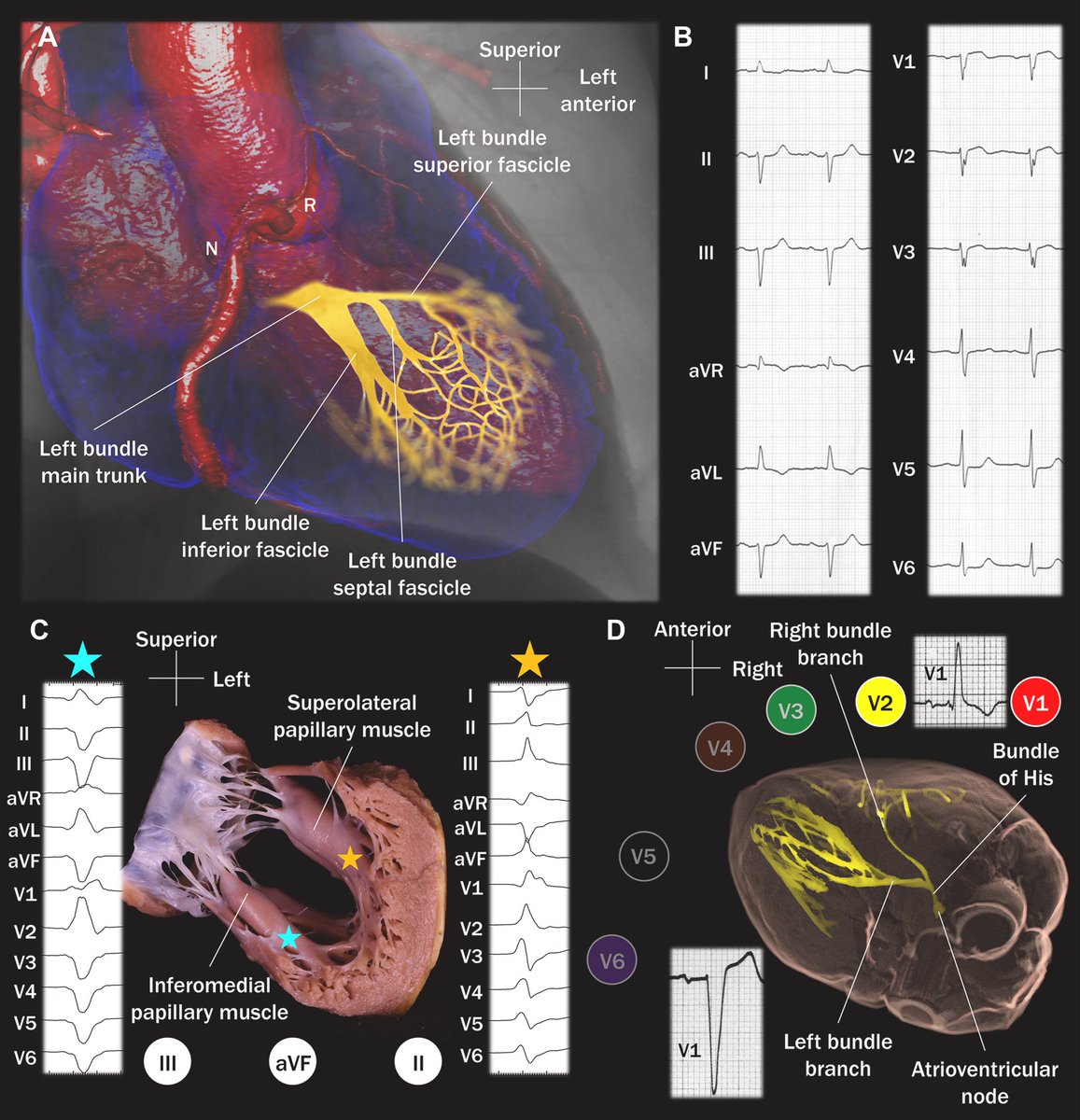 Really cool article on 12-Lead Electrocardiographic #Anatomy
Understanding cardiac anatomy is the key for understanding #POCUS as well.
🔗 jacc.org/doi/10.1016/j.…
#FOAMed #MedEd