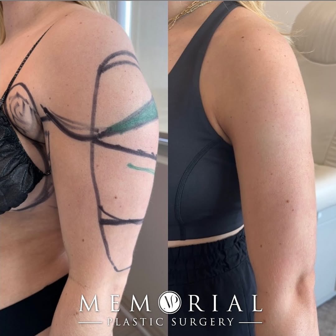 patrickhsumd's tweet photo. Arms looking slim and toned at 6 months post-op 💪🏼🤩🔥🔥

Procedure: Liposuction to arms 
(Pre-Sx: Wt: 150 Ht: 5’3 BMI: 26.6)
#liposuction #transformationTuesday #armtransformation #slimarms @MPS_Surgeons https://t.co/2iZx2x7Fgb