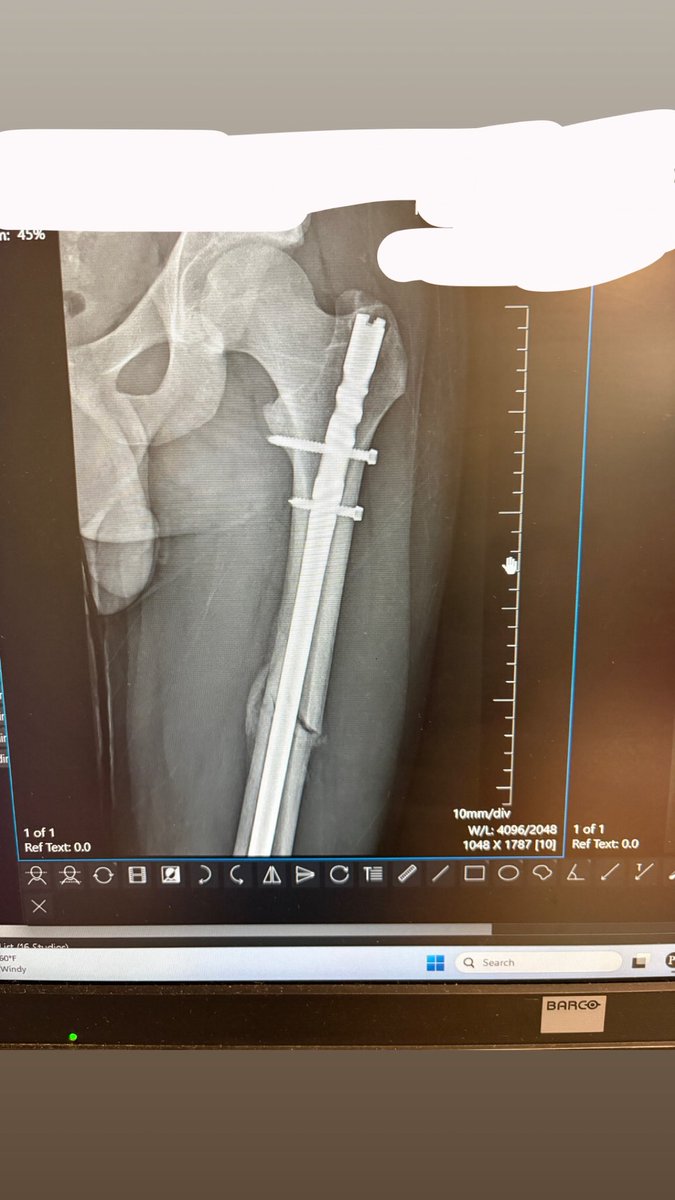 7 weeks post op, blessed to healing right now able to put pressure on my leg can’t wait for more of the recovery process excited to get back out there.!
<a href="/ChaseDonnonQB/">Chase Donnon</a> <a href="/MasterPatriots/">Master’s Academy Patriots</a> <a href="/EricKresser/">Eric Kresser</a>