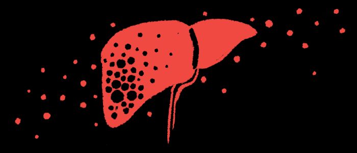 U.S. approval of Trikafta and other CFTR modulators may have reduced or delayed the need for liver transplants in CF-related liver disease. buff.ly/p5PvV3E #cysticfibrosis #cfwarrior #curecf #cysticfibrosislife