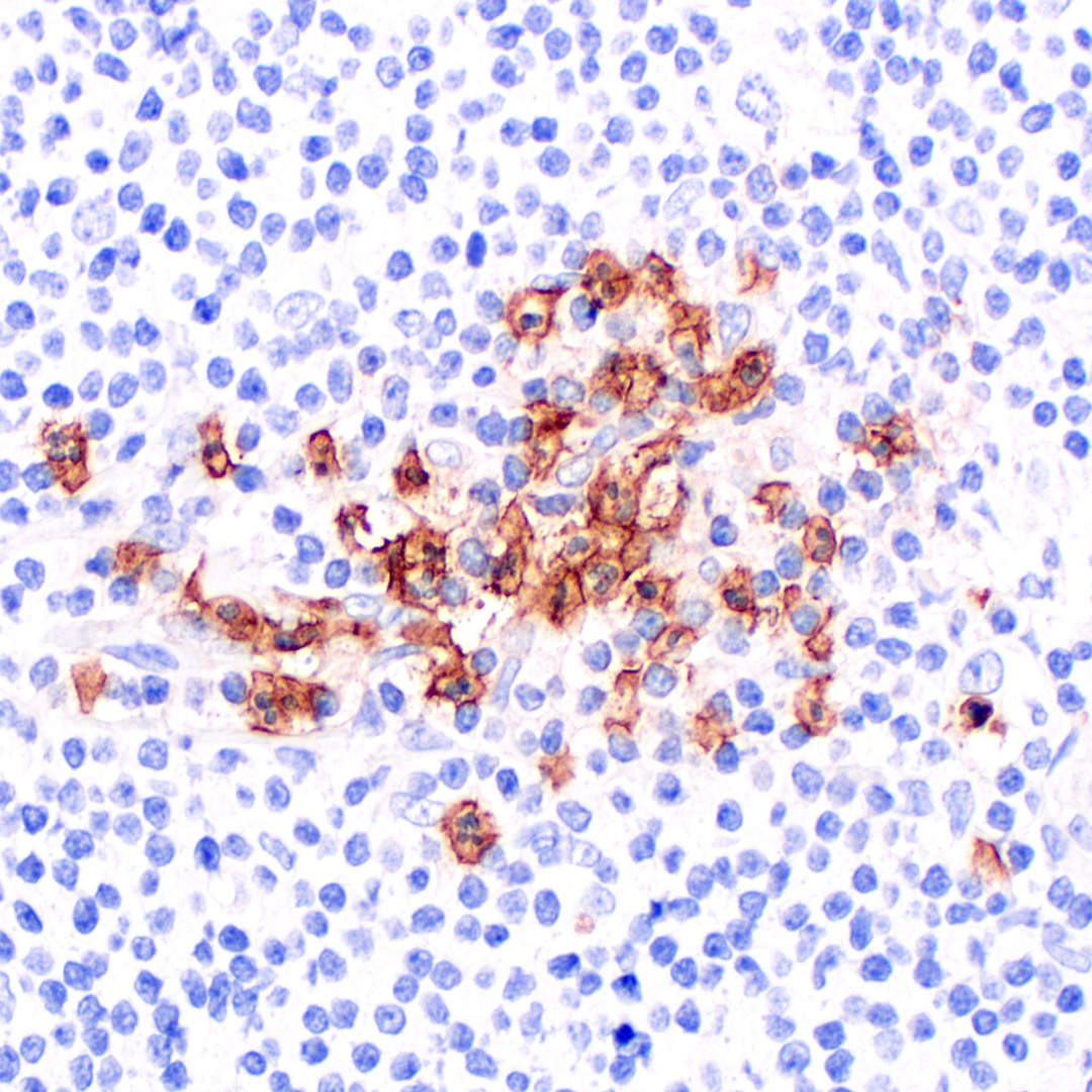 CellSignaling's tweet image. CD16 (FcγRIII) は、CD16-AとCD16-Bの2つの遺伝子によってコードされており、B細胞の活性化や抗体依存性細胞傷害、免疫複合体のクリアランスなどの様々な免疫機能に関連する膜糖タンパク質です。#61024は、ヒトサンプルのWBとIHC-Pに適しています。hubs.ly/Q03P-Zc70