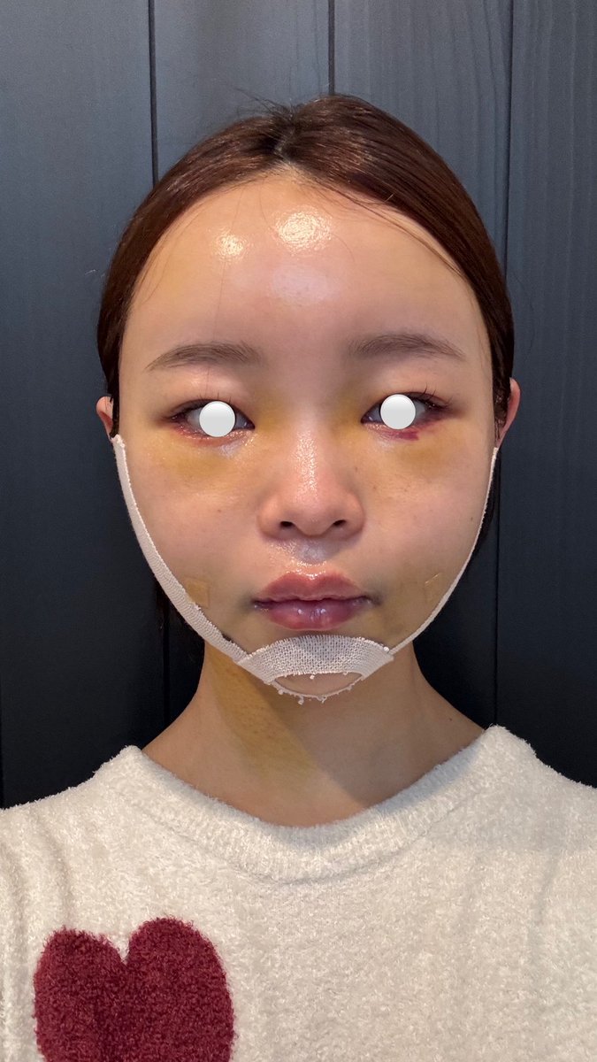__04221205's tweet photo. トップフェイスさん🏥@topfacejp

・フェイスラインの脂肪吸引
・フルフェイスの脂肪移植
・糸リフト6本 
・目の下脂肪再配置 

術後4日目！目元のテープも取れてだいぶスッキリ〜🫩🎶
血が出やすい体質だったみたいで、目元の赤みはちょっと時間かかるかもとのことでした！
おでこが綺麗すぎる〜！ https://t.co/nAbSyGfRU6
