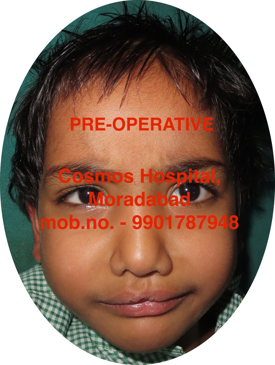 ANIRUDH_UP's tweet photo. #cleftlip #cleftlipandpalate #SmileTrainMoradabad #CosmosHospital https://t.co/obIk34Vykq
