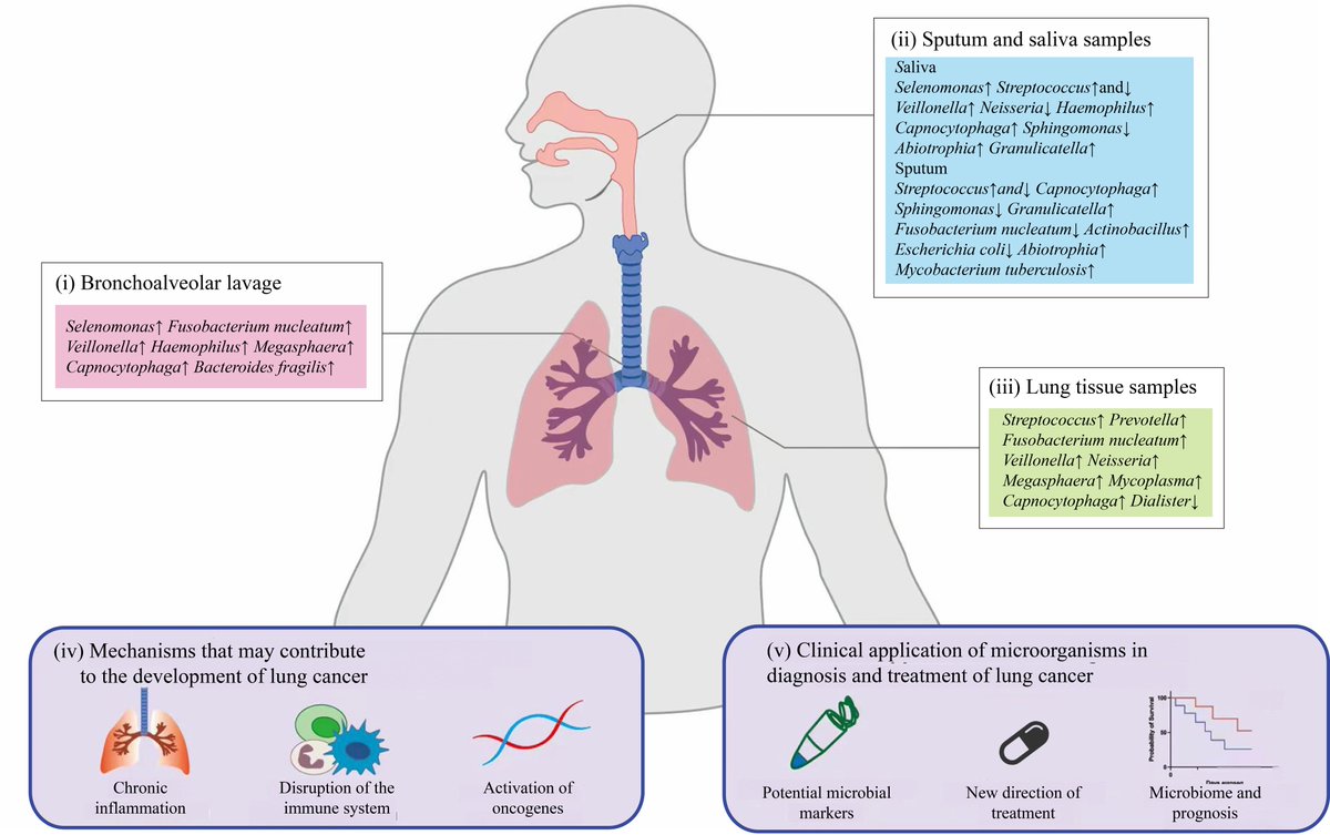 Journal_IMD's tweet photo. The lung microbiome is an active functional mediator of lung cancer pathogenesis, influencing progression through immune modulation and presenting a promising source of novel biomarkers and therapeutic targets.
https://t.co/eZfuZswyVA https://t.co/BamcErBh3y