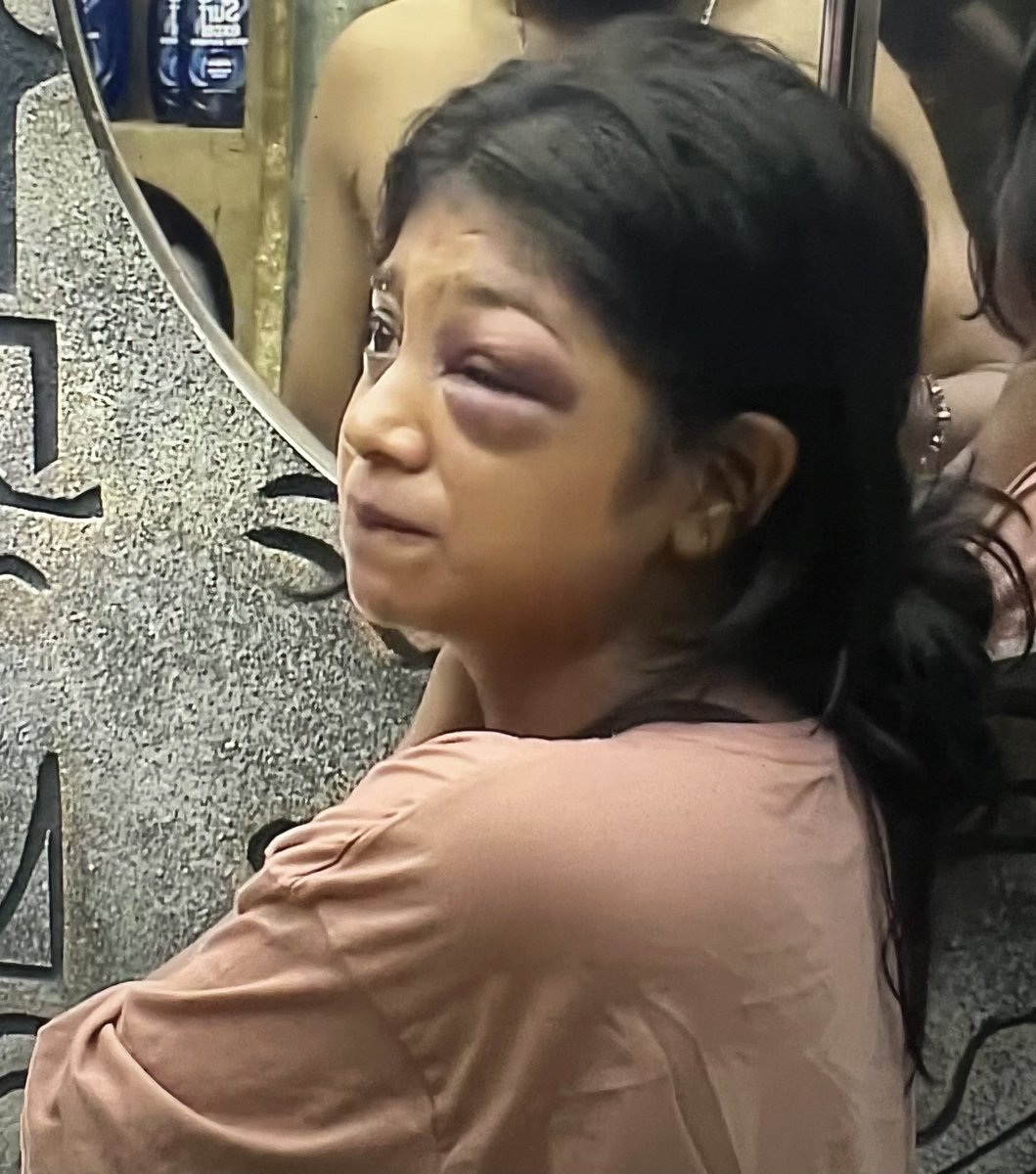 Universeboss111's tweet photo. Everytime i see her swollen eye 

"Naan venumnu than Adichen" echos in my ear.

Stay Strong #VJPaaru 💪

#BiggBossTamil9 #BiggBossTamil https://t.co/VMbEibXode