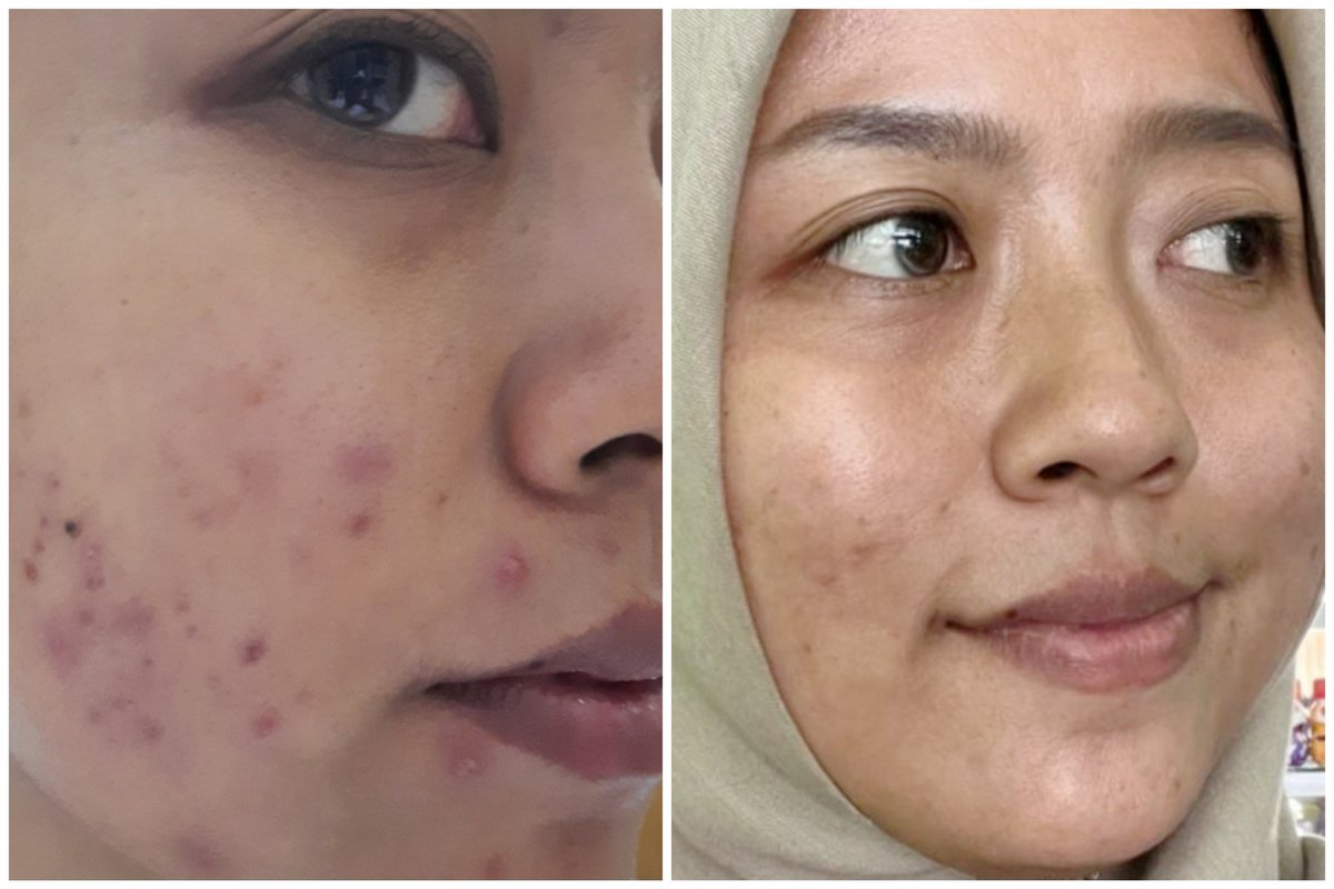 natriadelani's tweet photo. Kalau ingat 3 tahun lalu yang kulit wajah bener-bener jerawatan parah dan sekarang udah better banget tuh rasanya terharu ya, ga sia-sia buat effort cari produk yang cocok buat kondisi kulit aku yang jerawatan, dan produknya masih aku pakai sampai sekarang, produknya next! https://t.co/Fq7bAD7Gae