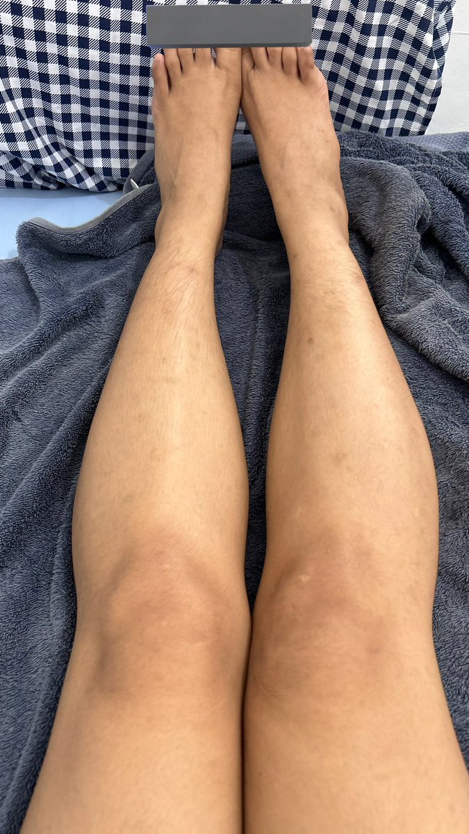 TW // bekas luka
(mff yh untuk yg jyjyk)

ilangin bekas luka cuma diedit😋
iya diedit pake lotion teratu 😃