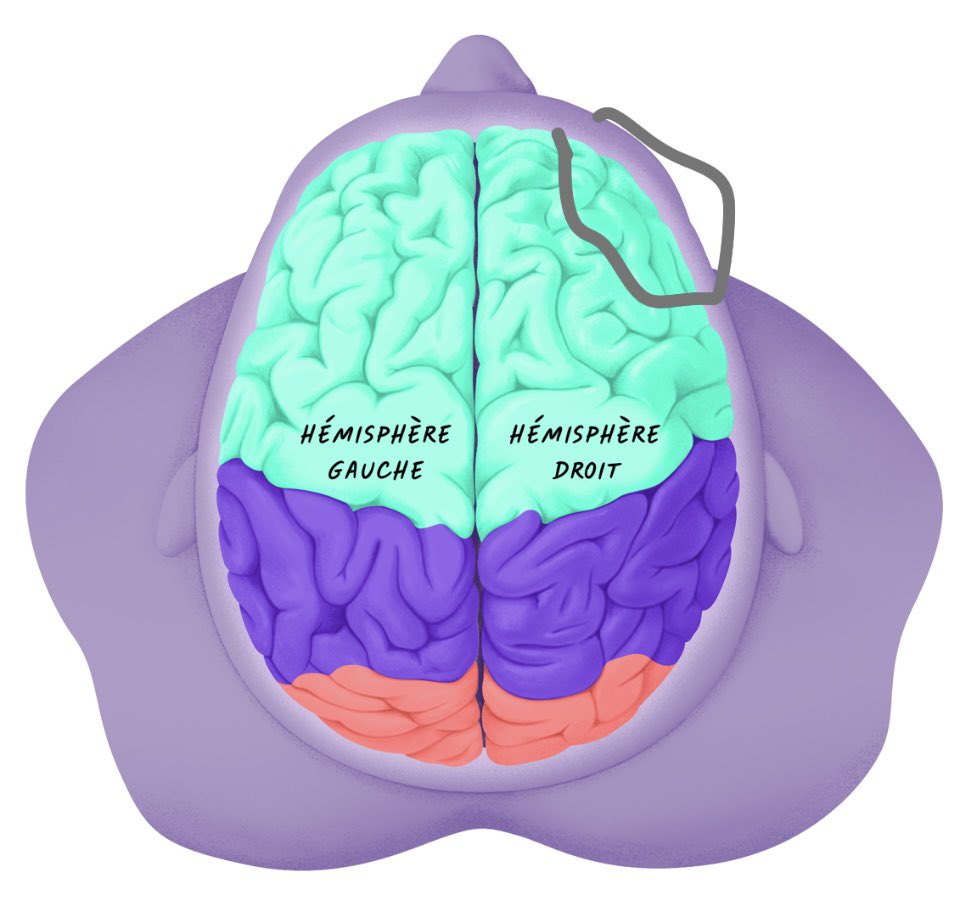 AkaneExtaly's tweet photo. @Deaconfrost1832 @finstreet @BeaupinEric Mon épilepsie vient d’une malformation du cerveau qui se situe sur la tempe à droite, et aucun médecin a dit que ça me rendait folle ou me faisait halluciner !! https://t.co/OK8ooyp2bN