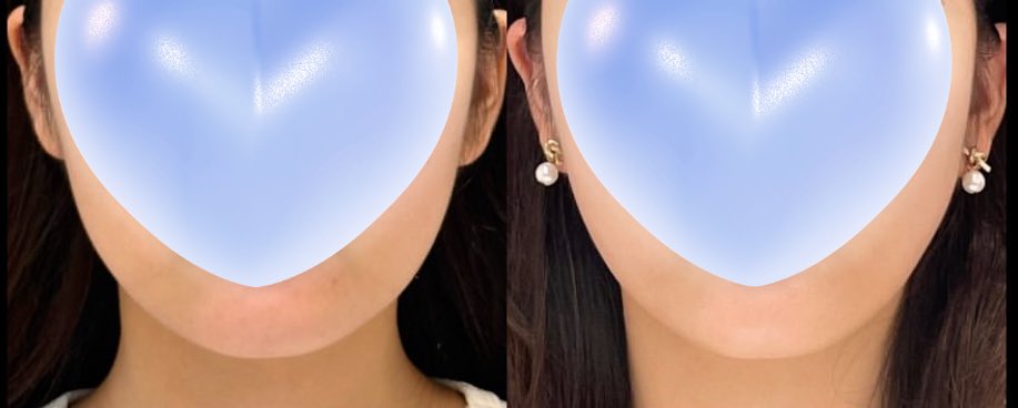 Iam_atheist0's tweet photo. フェイスライン顎下脂肪吸引、糸リフト
2ヶ月のビフォアフ

ナチュラルな変化で満足
ありがとう先生👩‍🏫 https://t.co/K4AEVmqlkD