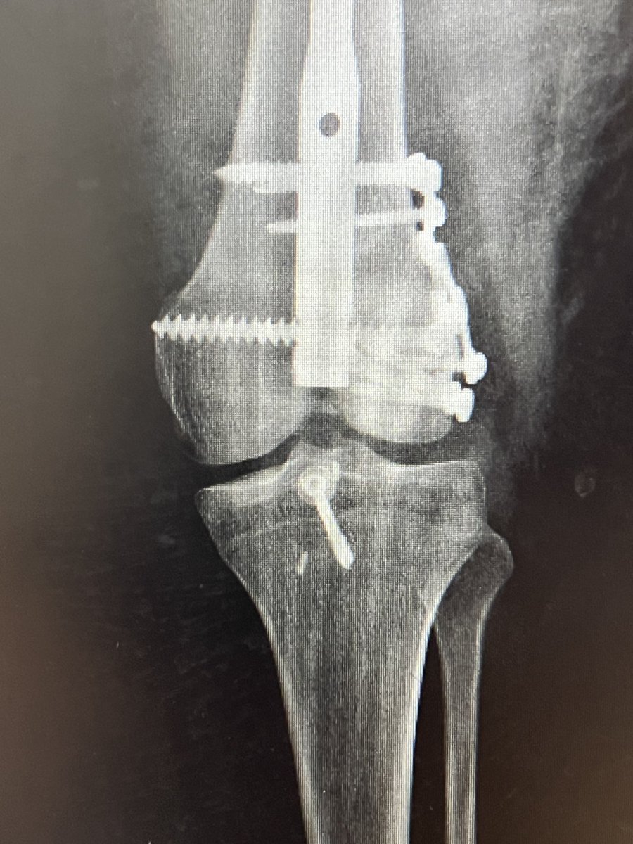 centerofhip's tweet image. I learned about the use of calcaneal plates in hoffa fractures from Twitter. It increases fixation points in comminuted fractures, enabling early mobilization.
#orthotwitter