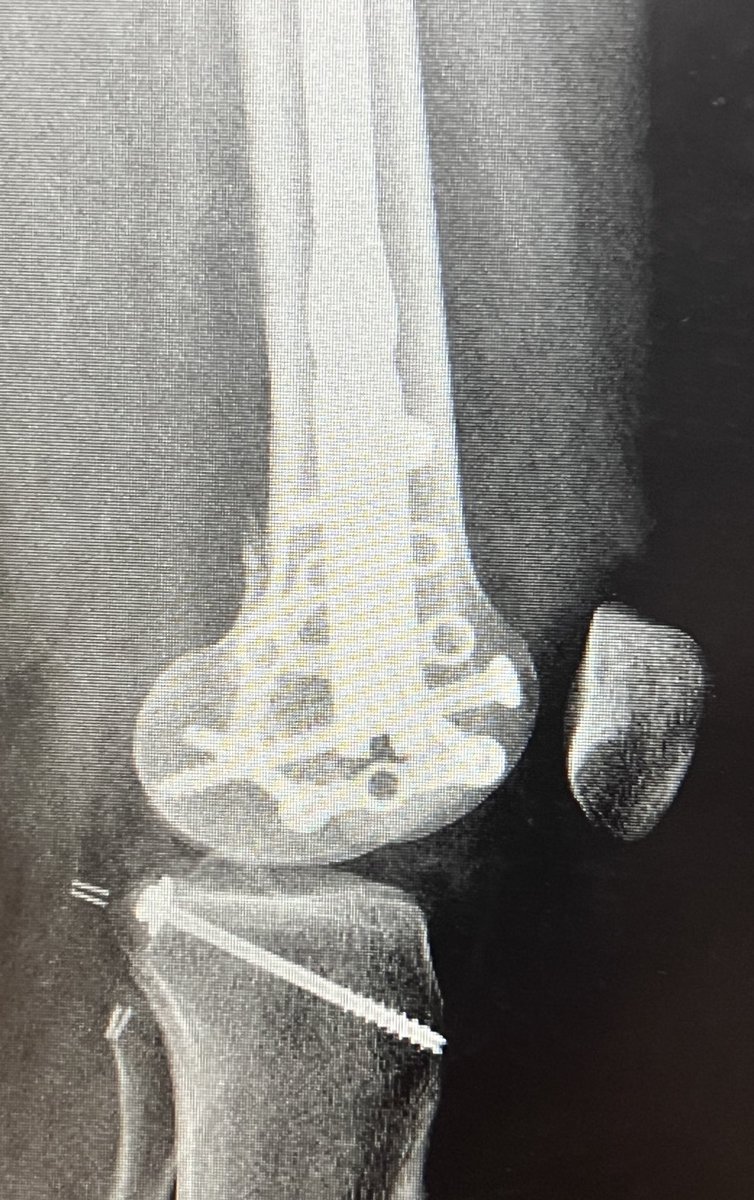 centerofhip's tweet image. I learned about the use of calcaneal plates in hoffa fractures from Twitter. It increases fixation points in comminuted fractures, enabling early mobilization.
#orthotwitter