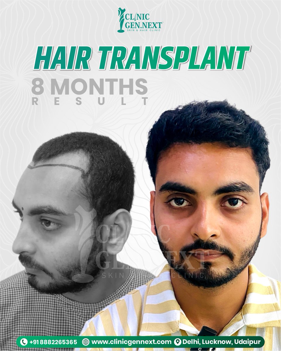 clinicgennext's tweet image. A transformation that speaks for itself! 💫
At ClinicGenNext, we restore not just hair—but confidence. 🙌
Here’s an incredible 8-month hair transplant result proving precision, expertise, and care deliver lasting results. 🌿

#DrKunalSingh #ClinicGenNext #BestHairTransplant
