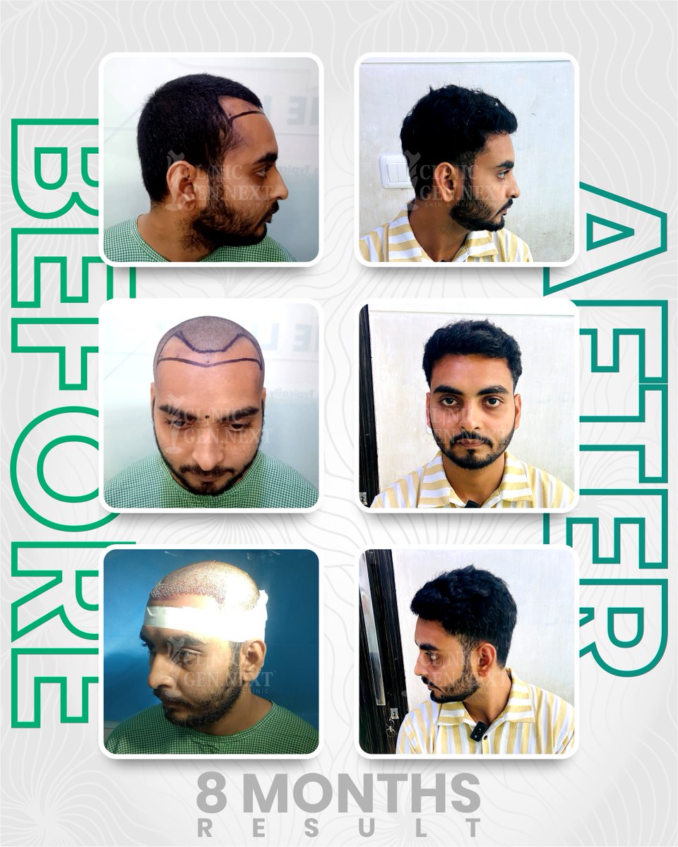 clinicgennext's tweet image. A transformation that speaks for itself! 💫
At ClinicGenNext, we restore not just hair—but confidence. 🙌
Here’s an incredible 8-month hair transplant result proving precision, expertise, and care deliver lasting results. 🌿

#DrKunalSingh #ClinicGenNext #BestHairTransplant