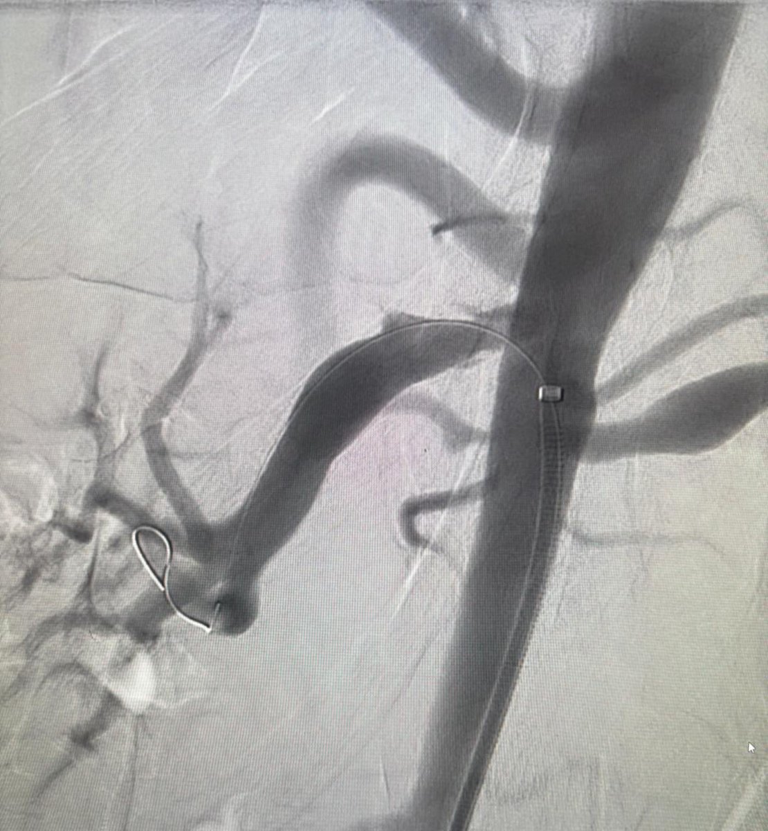 37 year old man, k/c neurofibromatosis type 1 with right renal artery stenosis and resistant hypertension. Balloon angioplasty was performed and nothing left behind.