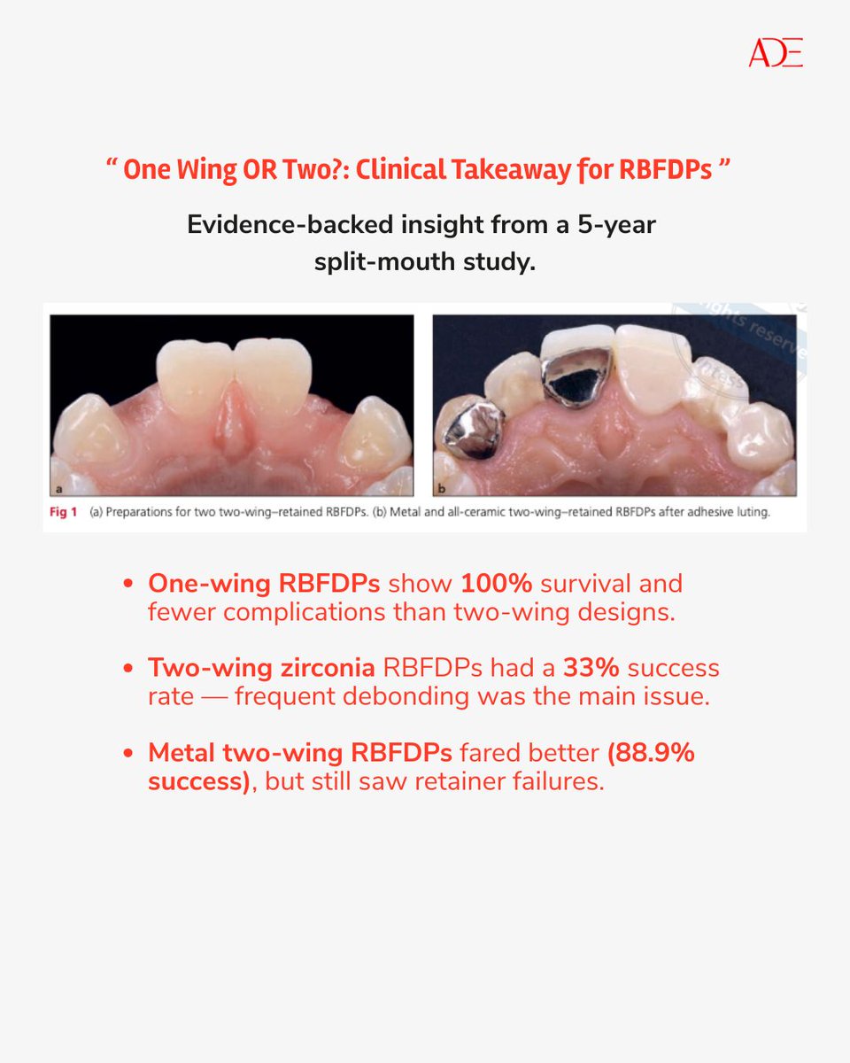 ADE_Dental's tweet photo. One Wing OR Two Clinical Takeaway for RBFDPs 

#adhesivebridges #dentallife #dentistry #dentaljournal #academyofdentalexcellence #ade #uk #profsubirbanerji #dentalpractice #dentaldiplomacourses https://t.co/1m88UAY5up