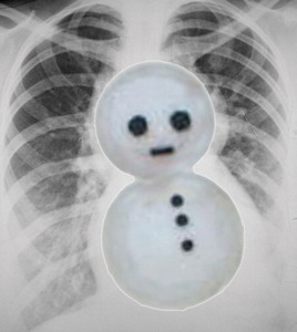 TrackYourHeart's tweet photo. A “snowman-shaped” cardiac silhouette is most classic for:
A) Total anomalous pulmonary venous connection (supracardiac)
B) Transposition of great arteries
C) Tetralogy of Fallot
D) Tricuspid atresia https://t.co/XIC7Pco3Ny