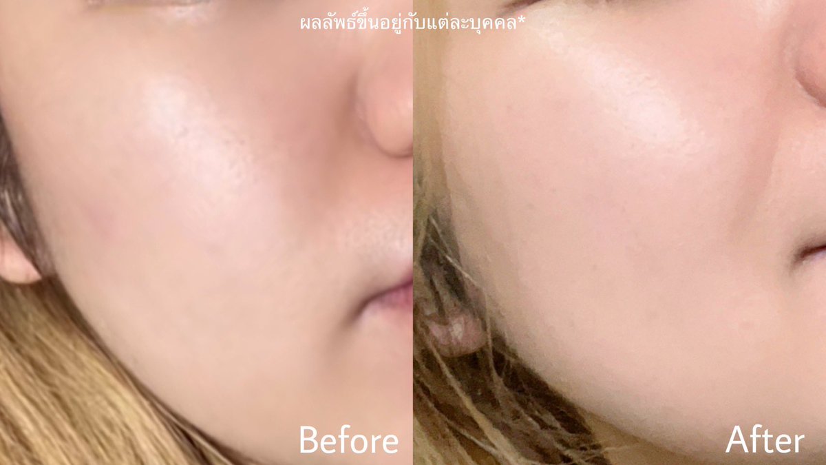 privmeime_'s tweet image. นี่ได้ NIVEA Skin Glow Serum มาแบบ1แถม1 เค้าเป็นตัวช่วยลดรอยดำรอยสิวเนื้อเซรั่มบางเบา ใช้ง่ายไม่เหนียวเลย ใช้แล้วผิวหน้าดูโกลว์ใสขึ้นในไม่กี่วันเองอ่ะ ตอนนี้มีโปรอยู่ ที่7-11 ถึง 12 พ.ย.68 น้า รีบเลย