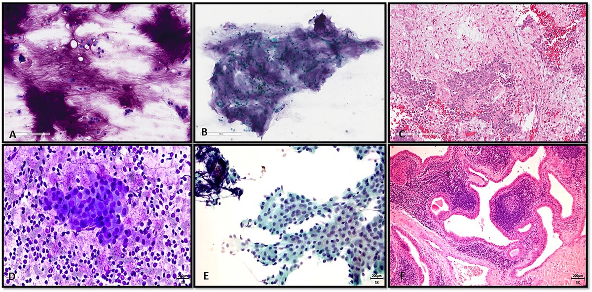 CancerCytopath's tweet image. 📣 Did you miss Companion Session 1, Advancements in Head &amp;amp; Neck #Cytopathology: Classification Systems, Dx Criteria and Dx Techniques featuring our EIC @bfaquin at #ASCyto25? 

Not to worry! Revisit Dr. Faquin&apos;s related work on the #MilanSystem here:

acsjournals.onlinelibrary.wiley.com/doi/10.1002/cn…