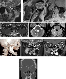 ESRJournals's tweet photo. ESR Essentials: Imaging of Facial Pain - Practice Recommendations by @ESHNRSociety 

This new article in the #ESREssentials series provides a clear, practice-oriented roadmap for radiologists evaluating facial and orofacial pain.

An expert consensus and practice recommendation paper by the European Society of Head and Neck Radiology (ESHNR), aligning imaging pathways with the International Classification of Orofacial Pain (ICOP) framework. (Darka Hadnadjev Šimonji et al.) #EuropeanRadiology

https://t.co/F3nAv78Upd 

"Facial pain is multifactorial, and a diagnostically complex complaint in head and neck. Imaging plays a pivotal but selective role. This consensus provides clarity on when and how to image, preventing both under- and over-imaging while improving diagnostic accuracy and patient care. It bridges everyday clinical uncertainty with structured, evidence-informed pathways that improve collaboration between dental, ENT, and radiology teams. A must-read for all radiologists interpreting head and neck imaging!" - Amit Gupta