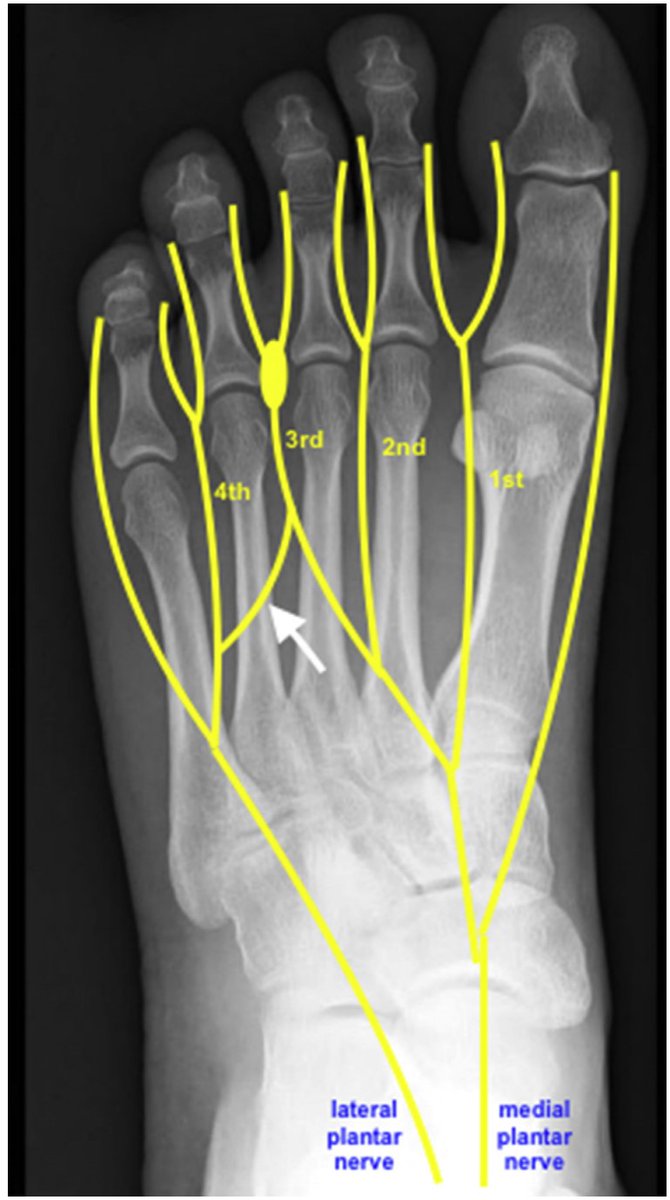 MedEd_Cases's tweet photo. Morton’s neuroma is a painful condition caused by thickening of the tissue around a digital nerve, most commonly between the third and fourth metatarsal heads, leading to sharp, burning pain or numbness in the forefoot. Diagnosis is typically clinical, based on localized tenderness and reproduction of symptoms with compression tests such as Mulder’s click or the foot squeeze test, sometimes supported by ultrasound or MRI. Treatment options range from footwear modification and corticosteroid injections to surgical excision of the affected nerve in refractory cases.

Read: https://t.co/uep1nNomPo

Watch: https://t.co/0ByeQHZt2h

#Orthopedics #SportsMedicine #EmergencyMedicine #MedicalEducation #PhysicalTherapy #AthleticTraining #Rehab #InjuryPrevention #Physio #SportsInjury #SportsRehab #PhysioTherapy #Meded #FOAMed