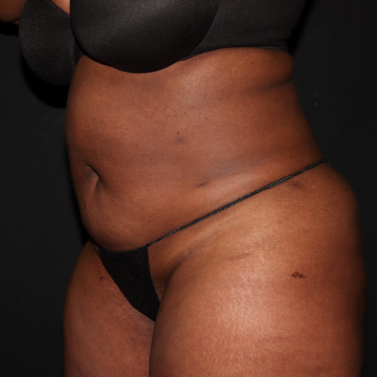 LaserVein's tweet image. Say goodbye to unwanted bra lines and hello to a confident new you! Witness the incredible transformation after our liposuction procedure. 
Book now at 636-614-1665!

#beforeandafter #liposuction #llvc