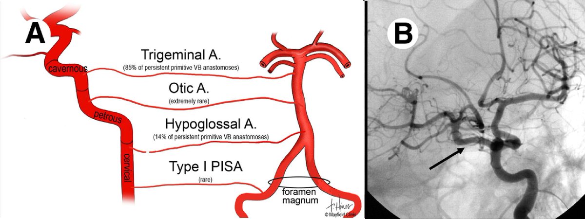 Vishalgargpgi's tweet photo. Wada test pitfall: primitive ICA–VB anastomoses. (A) Schematic of four variants that contraindicate ICA Amytal infusion. (B) Left ICA angiogram showing a persistent trigeminal artery filling the rostral basilar artery. PISA : Proatlantal InterSegmental Artery. https://t.co/HRRkr2U2MN