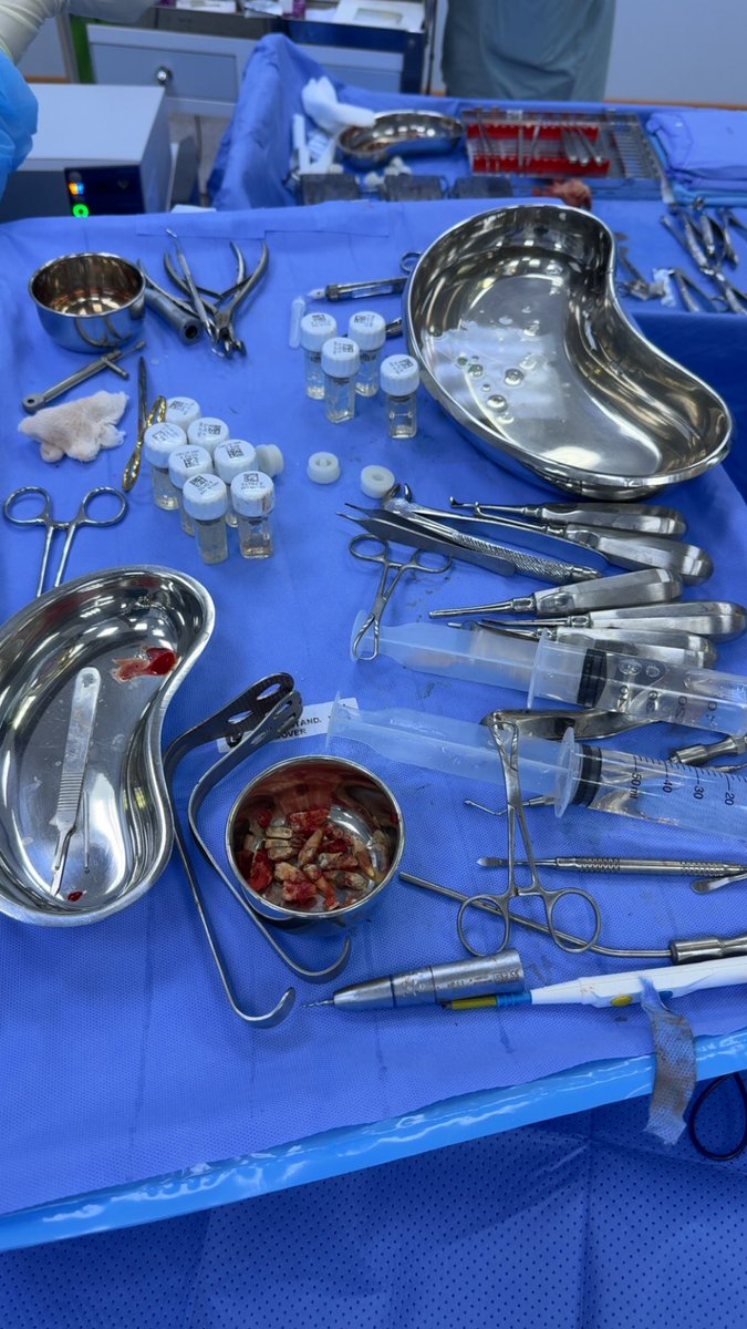 OR day 

All maxillary teeth and six mandibular teeth were extracted, and they were replaced with six implants in the maxilla and four implants in the mandible.