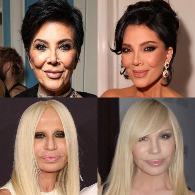 Kris Jenner and Donatella Versace before and after

What's really going on with these women?