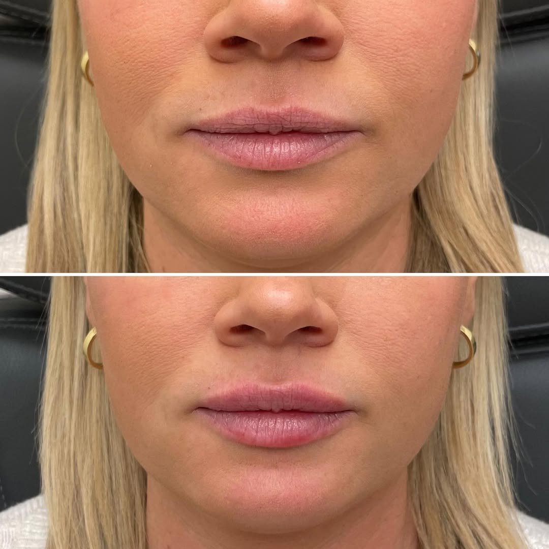 RaphaelBass03's tweet image. 0.5cc of RHA-2 for hydration. This patient came in requesting my signature “your lips, but better” look. Filler isn’t always about volume! Come see me &amp;amp; join the anti-duck lip movement!
.
.
.
#botox #lips #lipinjections #injectables #skincare #dermalfillers #fillers #medspa…
