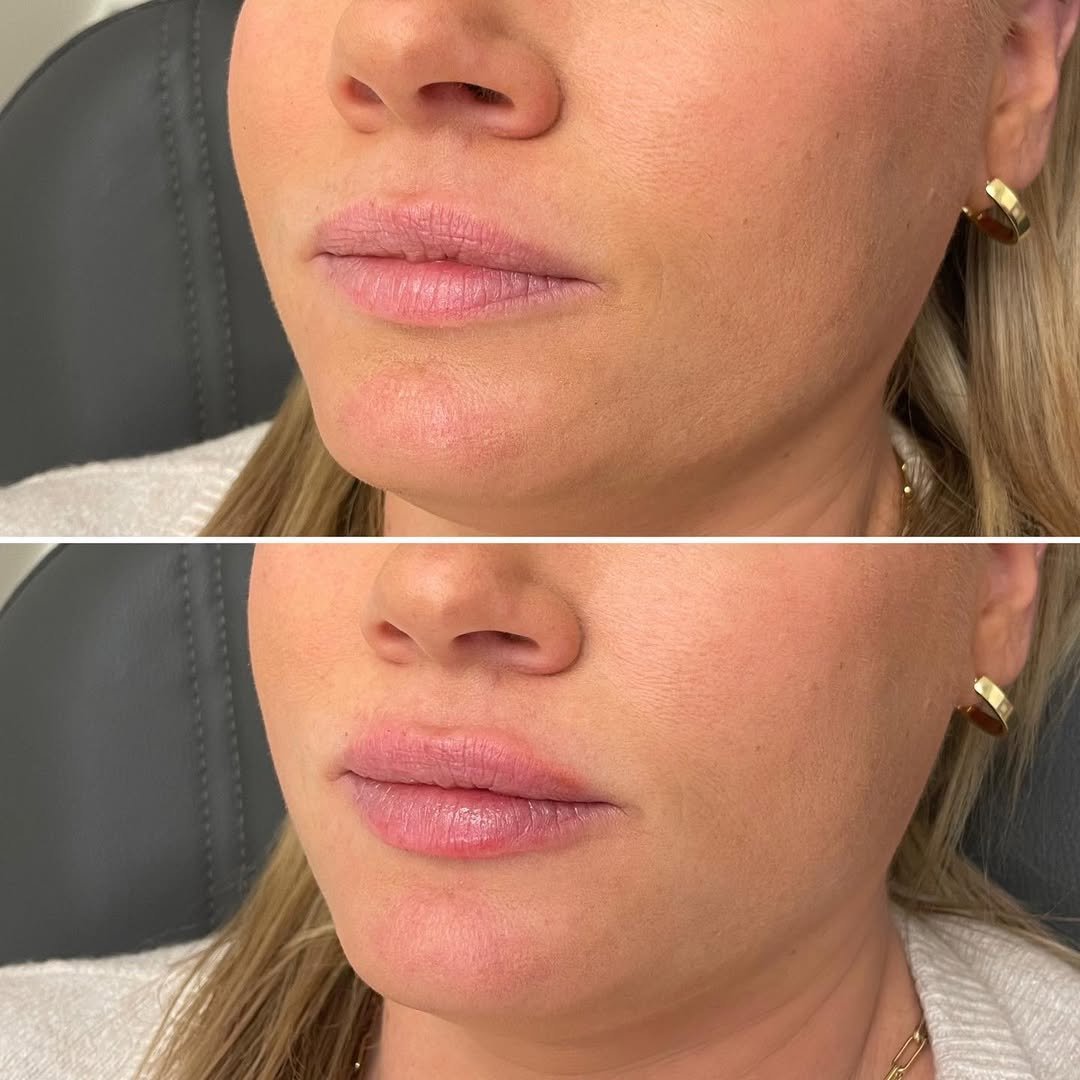 RaphaelBass03's tweet image. 0.5cc of RHA-2 for hydration. This patient came in requesting my signature “your lips, but better” look. Filler isn’t always about volume! Come see me &amp;amp; join the anti-duck lip movement!
.
.
.
#botox #lips #lipinjections #injectables #skincare #dermalfillers #fillers #medspa…