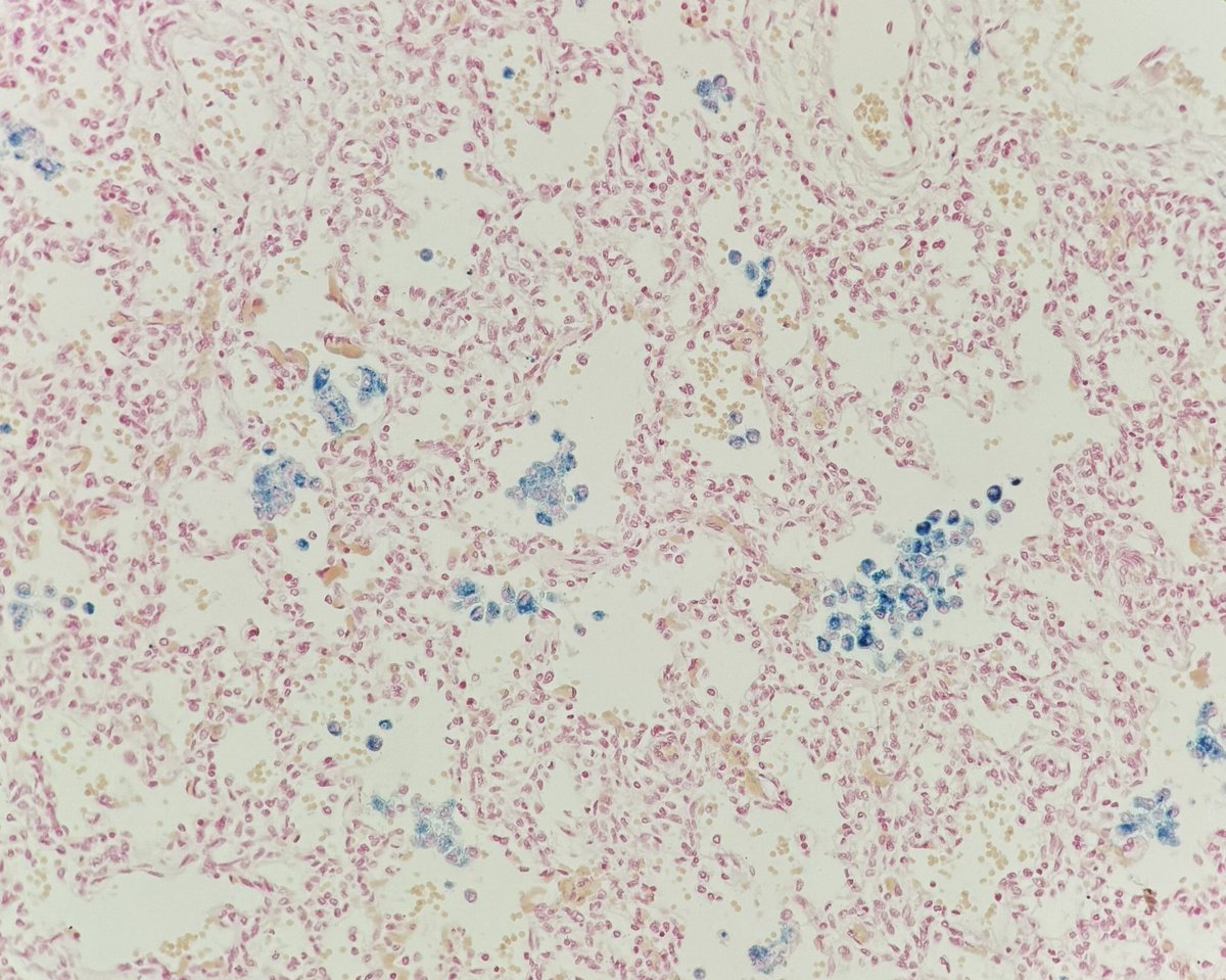 Hmmm. Infant lung. Any med students, residents, or fellows care to chime in first? #pathology #pedipath