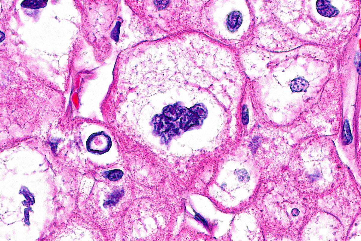ziad_zaatari's tweet image. 🔬📷 A big plump raisin! 🍇 ~ Nucleus with &quot;raisinoid&quot; features in a Chromophobe RCC ~ #GUpath #Pathology #PathArt