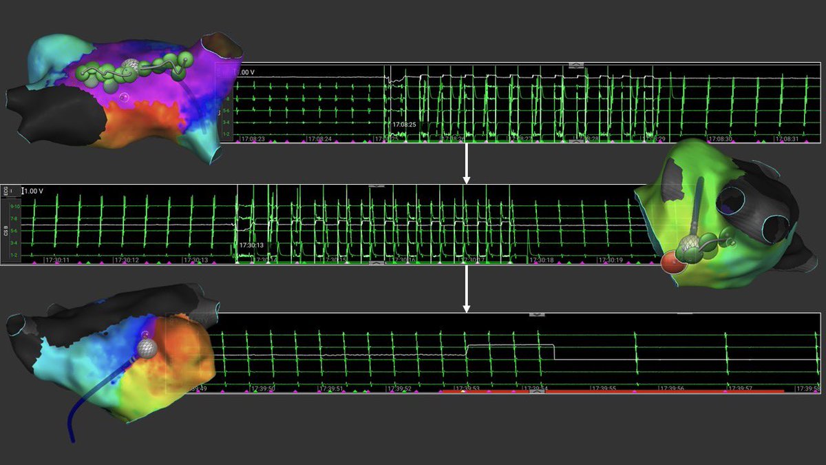 One patient, three atrial tachycardias.
All mapped and treated with precision using Affera system
<a href="/ipetemil/">Panagiotis Mililis</a> <a href="/Kariki_O/">Ourania Kariki</a> <a href="/athsaplaouras/">Athanasios Saplaouras</a> <a href="/SteliosDragasis/">Stelios</a> <a href="/K_Letsas/">Konstantinos Letsas</a> @ Vasilis Michopoulos  #Onasseio Hospital