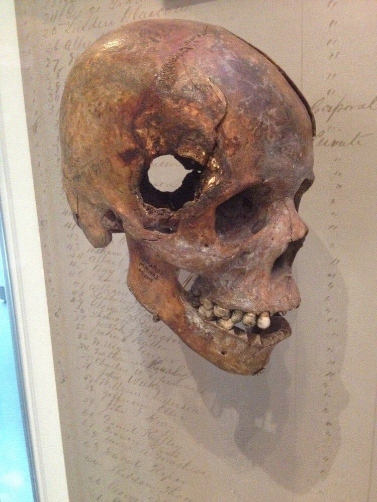 cooltechtipz's tweet photo. a civil war skull with a fatal wound. https://t.co/g40MiVw5uC