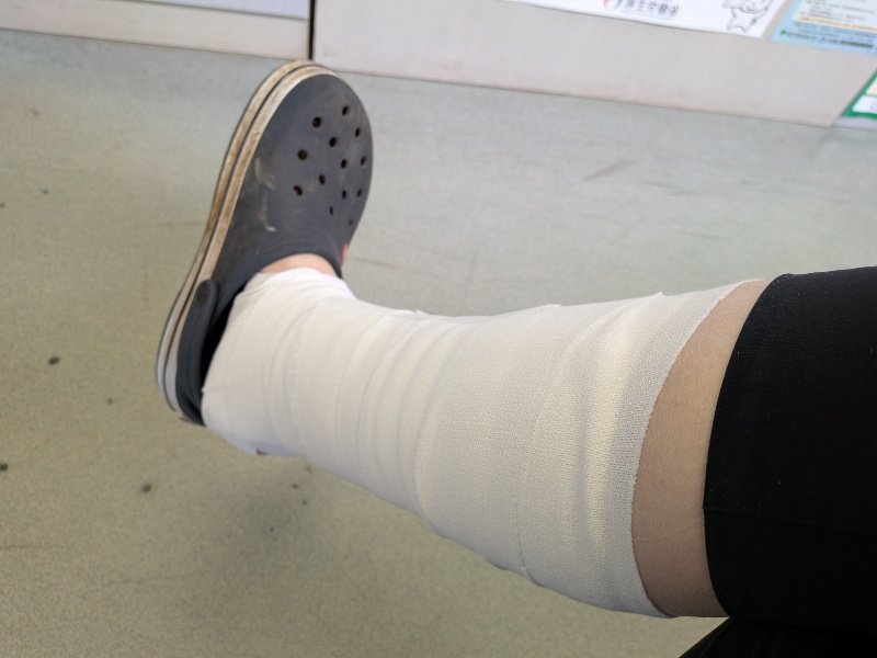 軟弱が過ぎて、「誰にでも簡単にできる」たかだか15〜20kgの荷物の入ったキャリーバッグ（L）を持って階段の昇降ができない上に、それを荷台に積んだ自転車のスタンドを立てられないので、今日の活動を断念した…😴
代わりに、整形外科へ行ってギプスを作ってもらった。全治3週間の予定。