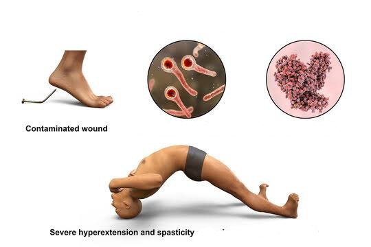 The antibiotic of choice for tetanus is:
A. Penicillin G
B. Amoxicillin
C. Azithromycin
D. Ciprofloxacin