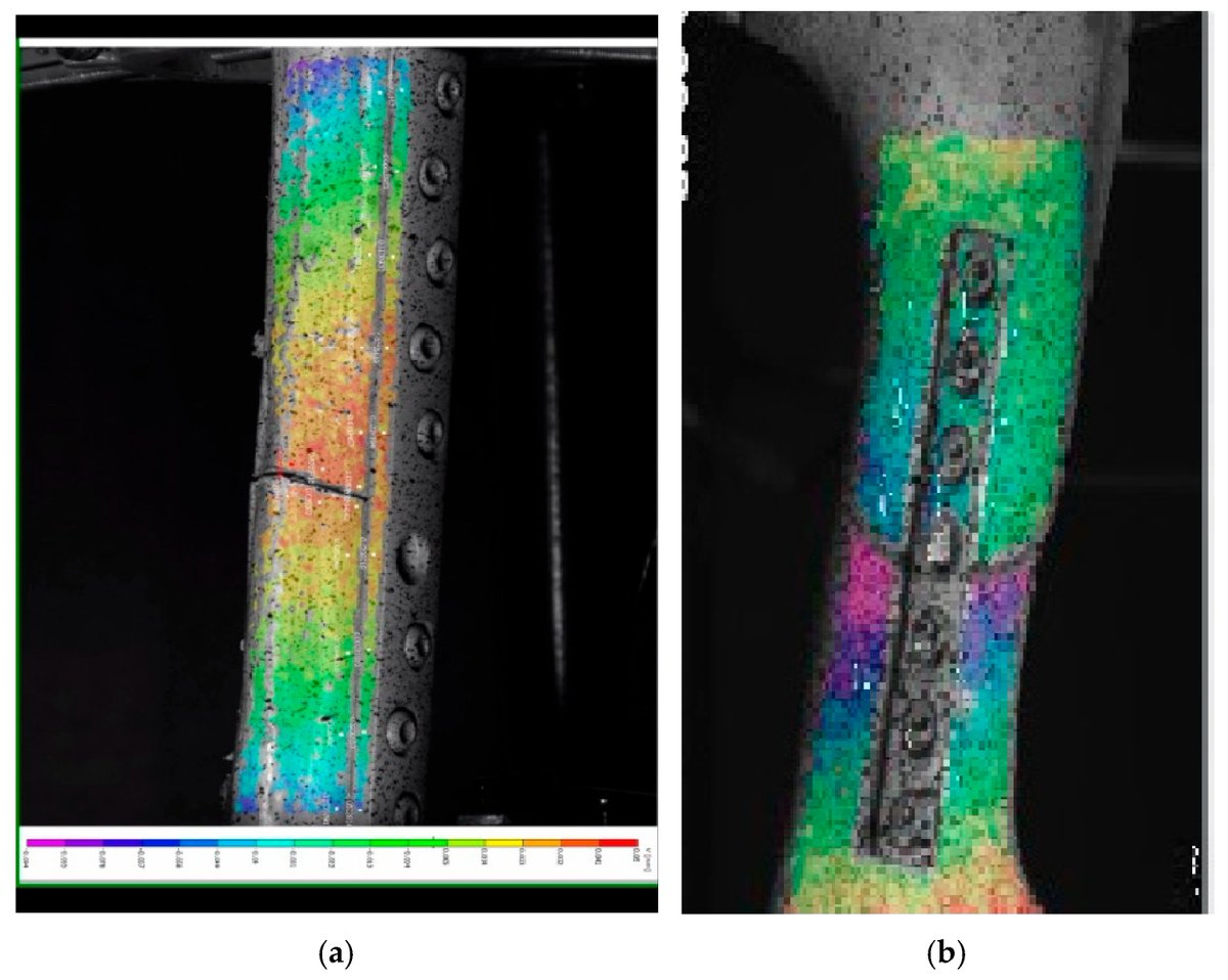 Prosthesis_MDPI's tweet image. 🦴🔍📊 A concise review + novel approaches for experimental analysis of fractured human bones—delivering rigorous insights for orthopedic &amp;amp; trauma research. 

doi.org/10.3390/prosth… 

#FracturedBoneAnalysis #OrthopedicResearch #TraumaBiomechanics