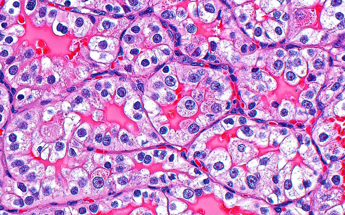 ziad_zaatari's tweet image. 🔬📸 Clear Cell Renal Cell Carcinoma ~ #GUpath #Pathology #PathArt