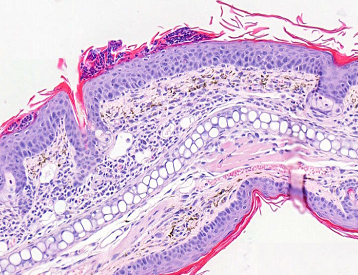 ScienceMagazine's tweet image. New @SciSignal findings show that cells called leukocytes have a surface “coating” that can be modified during inflammatory conditions, such as #psoriasis, revealing how immune cells are recruited to sites of inflammation. scim.ag/43fjlDV