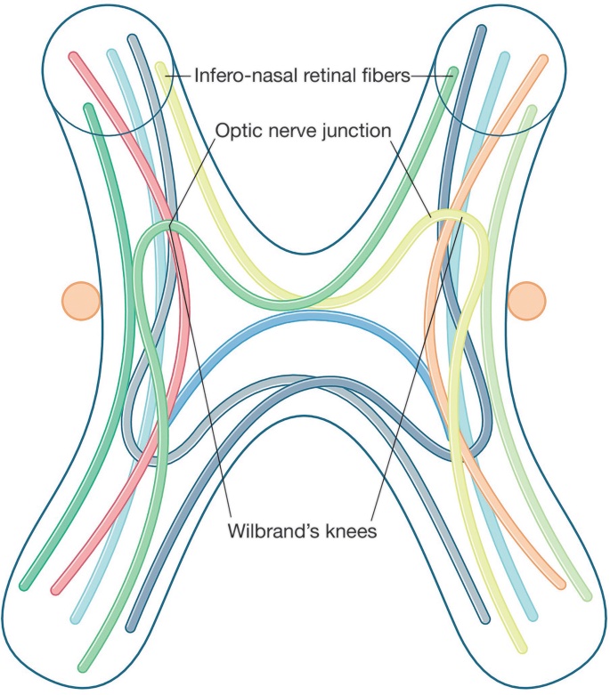 Beating drum sign in pituitary adenoma.

Inferonasal fibers are affected leading to superotemporal field defect.

#MedTwitter #ophthalmology #neetpg 
Image from google