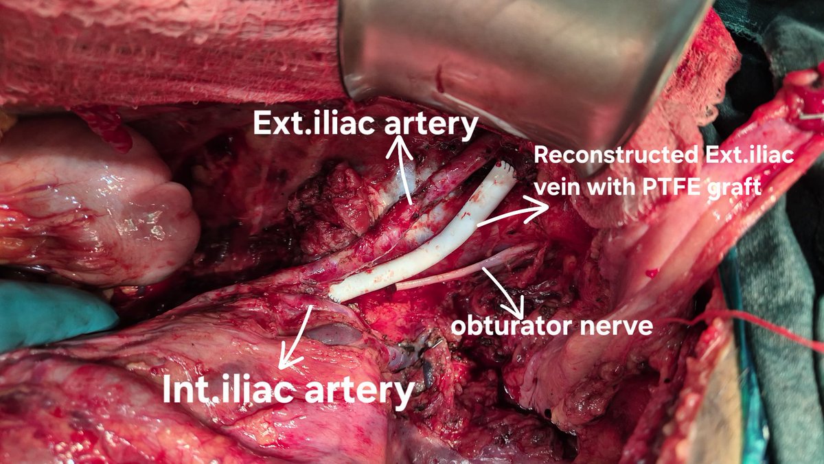 Mayank_Oncology's tweet photo. Compartmental resection for retroperitoneal sarcoma with en bloc excision of the involved  external iliac vein and PTFE graft reconstruction with 
sigmoidectomy and distal ureterectomy with  Boari flap.
@EAHPBA @IHPBA @AHPBA
@SanjayGovil8 @alegronchi https://t.co/TJcFhy2pue