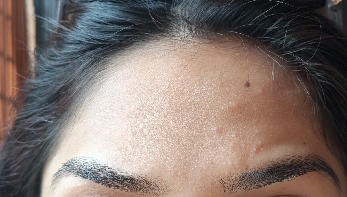 Can someone please tell me how to get rid of these red bumps from mosquito bites????They’re all over my face 😭