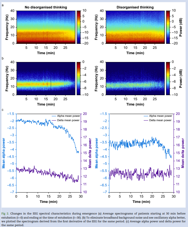 Propofol infusions during emergence, emergence characteristics, and the incidence of #delirium in the #PACU from Banerji et al. #AlphaMax