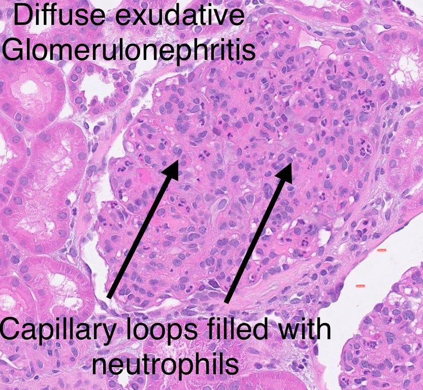 SethiRenalPath's tweet image. Simple recent case but so many things to teach.

LM: Diffuse proliferative GN
IF: granular IgG 1+, 3+ C3 3+
EM: numerous subepithelial humps, few subendothelial deposits.

Dx: Infection-related glomerulonephritis.

60 yr-old woman with acute kidney injury, hematuria, sepsis.