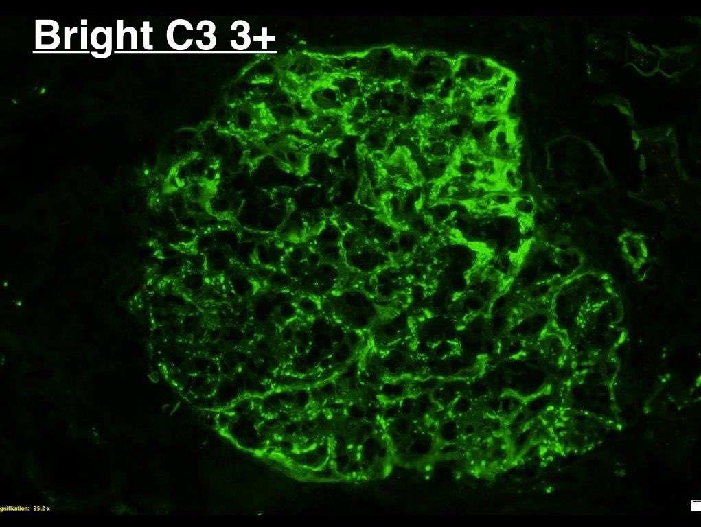 SethiRenalPath's tweet image. Simple recent case but so many things to teach.

LM: Diffuse proliferative GN
IF: granular IgG 1+, 3+ C3 3+
EM: numerous subepithelial humps, few subendothelial deposits.

Dx: Infection-related glomerulonephritis.

60 yr-old woman with acute kidney injury, hematuria, sepsis.