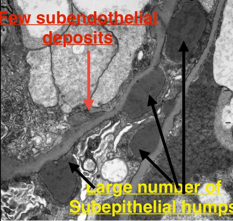 SethiRenalPath's tweet image. Simple recent case but so many things to teach.

LM: Diffuse proliferative GN
IF: granular IgG 1+, 3+ C3 3+
EM: numerous subepithelial humps, few subendothelial deposits.

Dx: Infection-related glomerulonephritis.

60 yr-old woman with acute kidney injury, hematuria, sepsis.