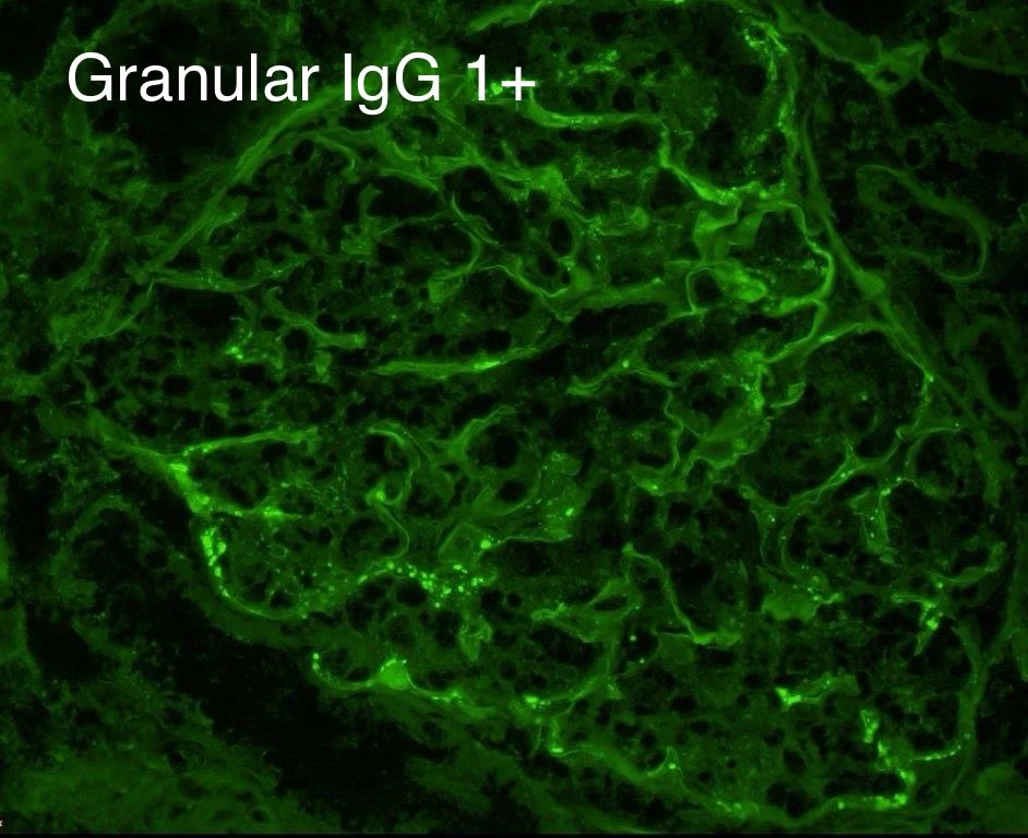 SethiRenalPath's tweet image. Simple recent case but so many things to teach.

LM: Diffuse proliferative GN
IF: granular IgG 1+, 3+ C3 3+
EM: numerous subepithelial humps, few subendothelial deposits.

Dx: Infection-related glomerulonephritis.

60 yr-old woman with acute kidney injury, hematuria, sepsis.