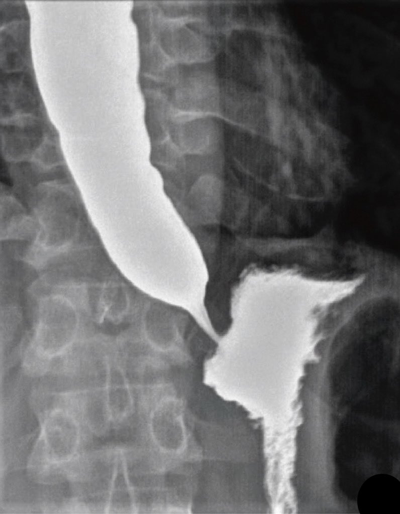 Dysphagia for liquids > solids 

what’s the sign called?

Diagnosis?